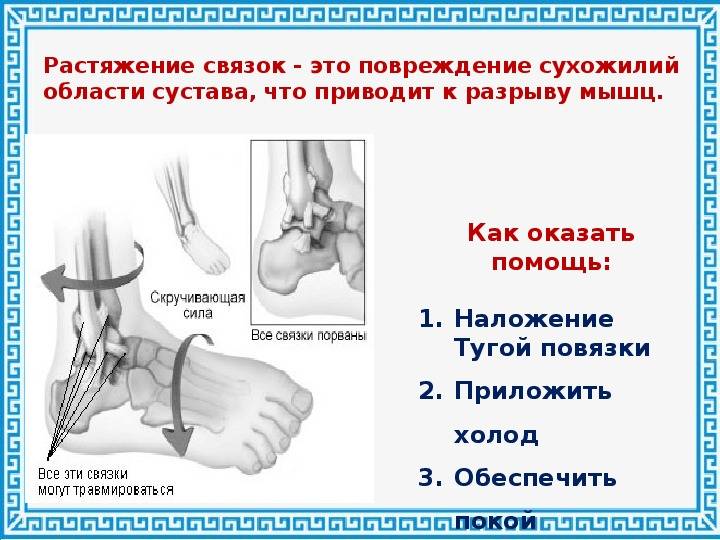 Первая помощь при растяжении связок