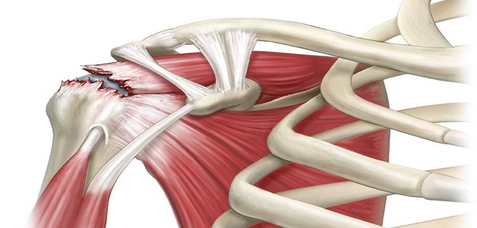 Вывихи плечевой кости в плечевом суставе – симптомы травмы, первая помощь и лечение, реабилитация – отделение травматологии цкб ран