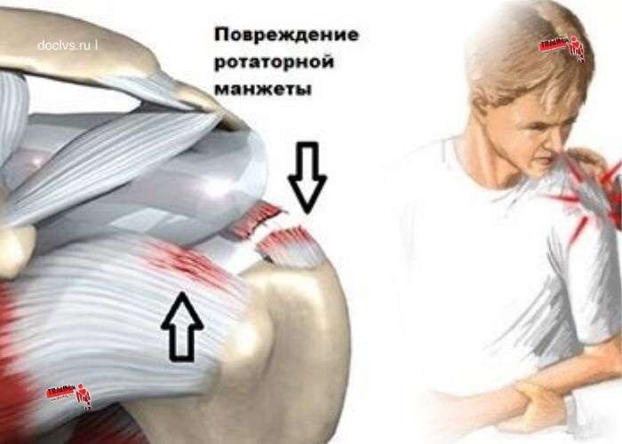 Лечение тендинита плечевого сустава [симптомы и диагностика]