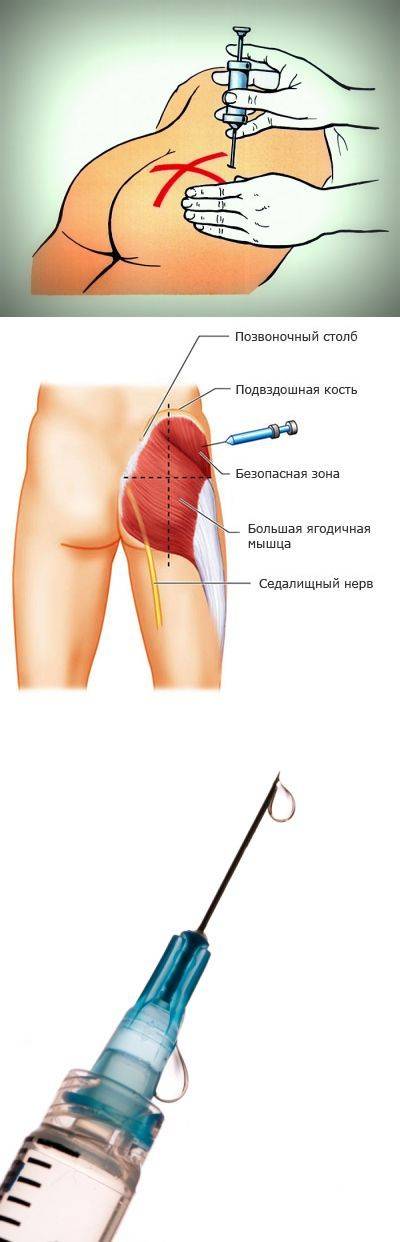 Как правильно делать укол?