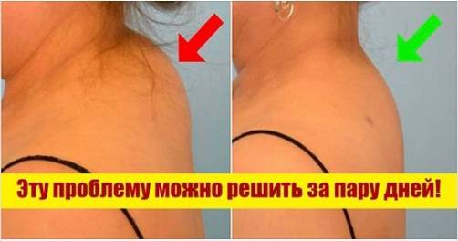 Головокружение при шейном остеохондрозе: приступы, симптомы, лечение | ким