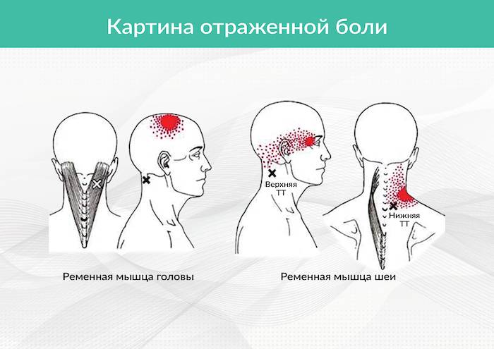 Болит голова и мышцы шеи. Ременная мышца шеи триггерные точки. Ременная мышца головы триггерные точки. Триггерные точки ременных мышц головы и шеи. Ременная мышца головы болит.
