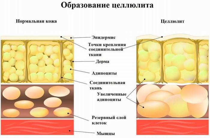 Какие существуют методы борьбы с целлюлитом