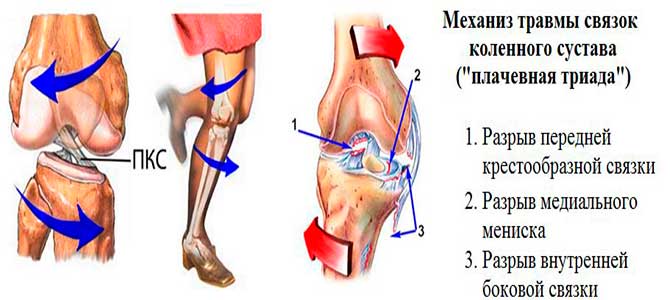 Изменения медиального мениска 1 степени. Перерастяжение связок коленного сустава. Растяжение сухожилия подколенного сустава. Подколенная связка коленного сустава. Симптомы повреждения сухожилия коленного сустава.