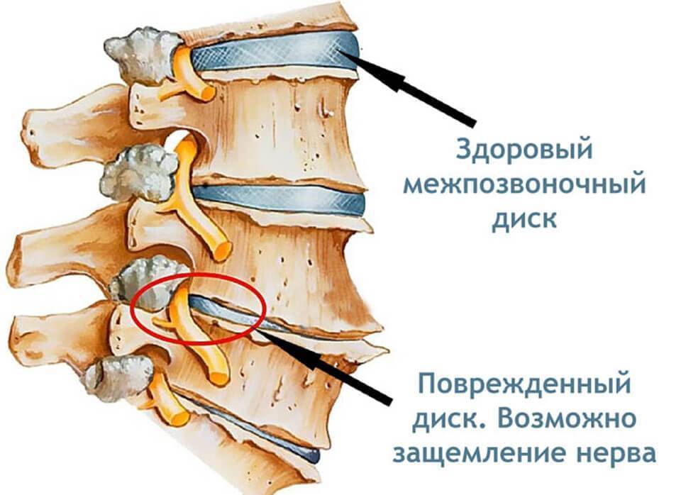 Межреберная невралгия