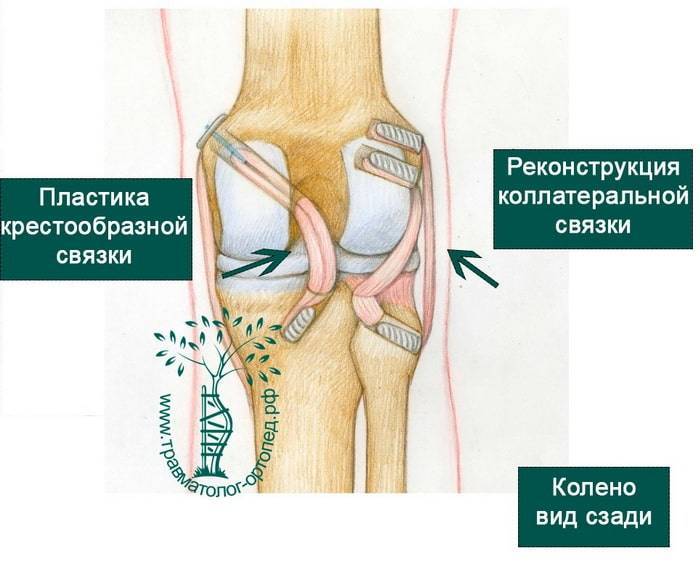 Артроз коленного сустава ️: симптомы, причины, диагностика и лечение