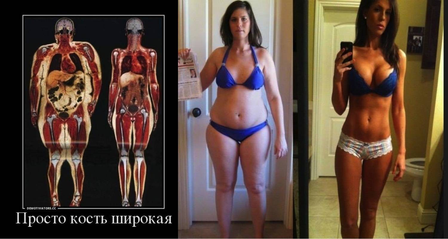 Все про остеопороз